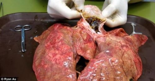 恐怖:吸下60根香烟后肺部的惊人变化