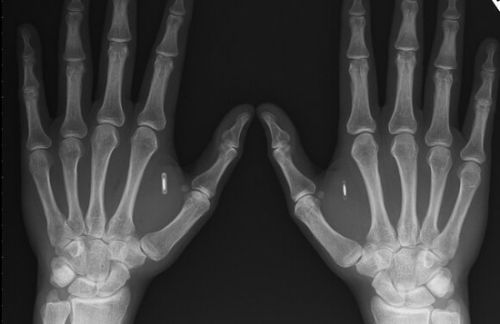 真爱!狂人将NFC芯片植入体内以解锁手机