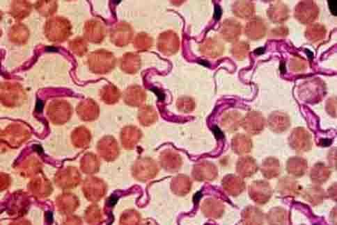 新艾滋病肆虐美国,已有30万人感染